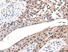 GJB2 / CX26 / Connexin 26 Antibody - Immunohistochemistry of paraffin-embedded Human esophagus cancer using GJB2 Polyclonal Antibody at dilution of 1:100.