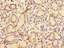 GJB2 / CX26 / Connexin 26 Antibody - Immunohistochemistry of paraffin-embedded human gastric cancer using GJB2 Antibody at dilution of 1:100