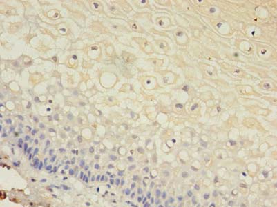 GJB3 / CX31 / Connexin 31 Antibody - Immunohistochemistry of paraffin-embedded human cervical cancer using antibody at dilution of 1:100.