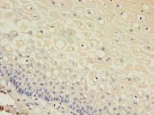 GJB3 / CX31 / Connexin 31 Antibody - Immunohistochemistry of paraffin-embedded human cervical cancer using antibody at dilution of 1:100.