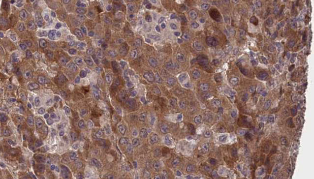 GJB3 / CX31 / Connexin 31 Antibody - 1:100 staining human liver carcinoma tissues by IHC-P. The sample was formaldehyde fixed and a heat mediated antigen retrieval step in citrate buffer was performed. The sample was then blocked and incubated with the antibody for 1.5 hours at 22°C. An HRP conjugated goat anti-rabbit antibody was used as the secondary.