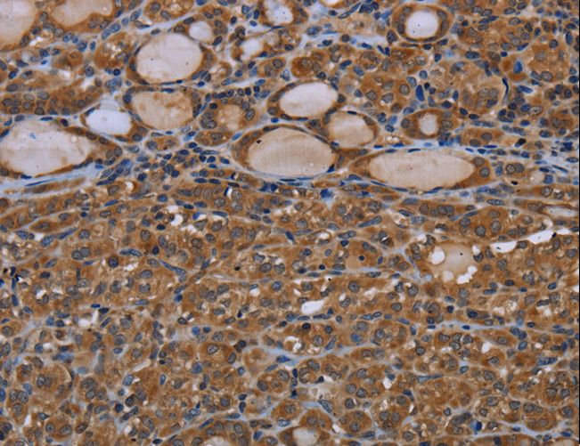 GJB4 / CX30.3 / Connexin 30.3 Antibody - Immunohistochemistry of paraffin-embedded Human thyroid cancer using GJB4 Polyclonal Antibody at dilution of 1:40.