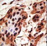 GJB6 / CX30 / Connexin 30 Antibody - Formalin-fixed and paraffin-embedded human cancer tissue reacted with the primary antibody, which was peroxidase-conjugated to the secondary antibody, followed by AEC staining. This data demonstrates the use of this antibody for immunohistochemistry; clinical relevance has not been evaluated. BC = breast carcinoma; HC = hepatocarcinoma.