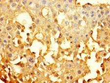 GJB6 / CX30 / Connexin 30 Antibody - Immunohistochemistry of paraffin-embedded human breast cancer using GJB6 Antibody at dilution of 1:100