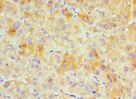 GJC1 / CX45 / Connexin 45 Antibody - Immunohistochemistry of paraffin-embedded human liver cancer using antibody at 1:100 dilution.