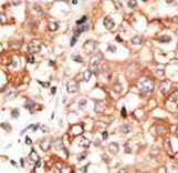 GJC1 / CX45 / Connexin 45 Antibody - Formalin-fixed and paraffin-embedded human cancer tissue reacted with the primary antibody, which was peroxidase-conjugated to the secondary antibody, followed by DAB staining. This data demonstrates the use of this antibody for immunohistochemistry; clinical relevance has not been evaluated. BC = breast carcinoma; HC = hepatocarcinoma.