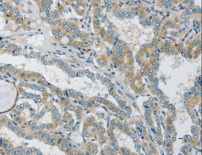GJC1 / CX45 / Connexin 45 Antibody - Immunohistochemistry of paraffin-embedded Human thyroid cancer using GJC1 Polyclonal Antibody at dilution of 1:50.