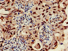 GJC1 / CX45 / Connexin 45 Antibody - Immunohistochemistry of paraffin-embedded human lung cancer at dilution of 1:100