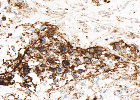 GJC1 / CX45 / Connexin 45 Antibody - 1:100 staining human liver carcinoma tissues sections by IHC-P. The tissue was formaldehyde fixed and a heat mediated antigen retrieval step in citrate buffer was performed. The tissue was then blocked and incubated with the antibody for 1.5 hours at 22°C. An HRP conjugated goat anti-rabbit antibody was used as the secondary.