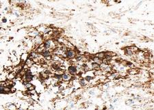 GJC1 / CX45 / Connexin 45 Antibody - 1:100 staining human liver carcinoma tissues sections by IHC-P. The tissue was formaldehyde fixed and a heat mediated antigen retrieval step in citrate buffer was performed. The tissue was then blocked and incubated with the antibody for 1.5 hours at 22°C. An HRP conjugated goat anti-rabbit antibody was used as the secondary.