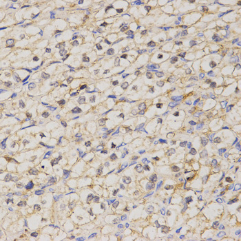 GJC2 Antibody - Immunohistochemistry of paraffin-embedded human kidney cancer tissue.