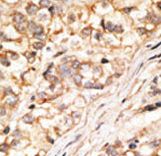 GJD2 / CX36 / Connexin 36 Antibody - Formalin-fixed and paraffin-embedded human cancer tissue reacted with the primary antibody, which was peroxidase-conjugated to the secondary antibody, followed by DAB staining. This data demonstrates the use of this antibody for immunohistochemistry; clinical relevance has not been evaluated. BC = breast carcinoma; HC = hepatocarcinoma.
