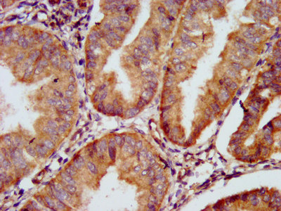 GJD2 / CX36 / Connexin 36 Antibody - Immunohistochemistry image at a dilution of 1:500 and staining in paraffin-embedded human endometrial cancer performed on a Leica BondTM system. After dewaxing and hydration, antigen retrieval was mediated by high pressure in a citrate buffer (pH 6.0) . Section was blocked with 10% normal goat serum 30min at RT. Then primary antibody (1% BSA) was incubated at 4 °C overnight. The primary is detected by a biotinylated secondary antibody and visualized using an HRP conjugated SP system.