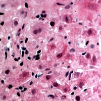 GK / Glycerol Kinase Antibody - Immunohistochemical analysis of Glycerol Kinase 1 staining in human liver cancer formalin fixed paraffin embedded tissue section. The section was pre-treated using heat mediated antigen retrieval with sodium citrate buffer (pH 6.0). The section was then incubated with the antibody at room temperature and detected with HRP and AEC as chromogen. The section was then counterstained with hematoxylin and mounted with DPX.