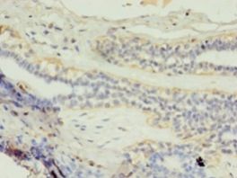 GK2 / Glycerol Kinase 2 Antibody - Immunohistochemistry of paraffin-embedded human breast cancer using antibody at 1:100 dilution.  This image was taken for the unconjugated form of this product. Other forms have not been tested.