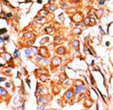 GK2 / Glycerol Kinase 2 Antibody - Formalin-fixed and paraffin-embedded human cancer tissue reacted with the primary antibody, which was peroxidase-conjugated to the secondary antibody, followed by AEC staining. This data demonstrates the use of this antibody for immunohistochemistry; clinical relevance has not been evaluated. BC = breast carcinoma; HC = hepatocarcinoma.