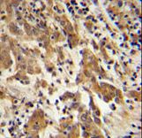 GKAP1 Antibody - GKAP1 Antibody immunohistochemistry of formalin-fixed and paraffin-embedded human cervix carcinoma followed by peroxidase-conjugated secondary antibody and DAB staining.