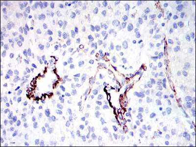 GKAP1 Antibody - IHC of paraffin-embedded human liver cancer tissues using GKAP mouse monoclonal antibody with DAB staining.