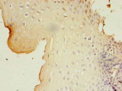 GKAP1 Antibody - Immunohistochemistry of paraffin-embedded human cervical cancer using antibody at dilution of 1:100.