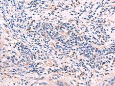 GKAP1 Antibody - Immunohistochemistry of paraffin-embedded Human cervical cancer tissue  using GKAP1 Polyclonal Antibody at dilution of 1:95(×200)