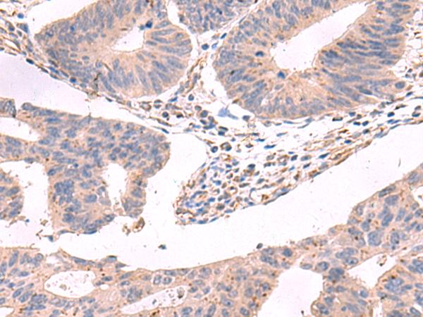 GKAP1 Antibody - Immunohistochemistry of paraffin-embedded Human colorectal cancer tissue  using GKAP1 Polyclonal Antibody at dilution of 1:95(×200)