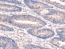 GKAP1 Antibody - Immunohistochemistry of paraffin-embedded Human colorectal cancer tissue  using GKAP1 Polyclonal Antibody at dilution of 1:100(×200)