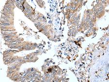 GKN1 / Gastrokine 1 Antibody - Immunohistochemistry of paraffin-embedded Human colorectal cancer tissue  using GKN1 Polyclonal Antibody at dilution of 1:30(×200)
