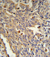 GLA / Alpha Galactosidase Antibody - GLA Antibody IHC of formalin-fixed and paraffin-embedded human Lung carcinoma followed by peroxidase-conjugated secondary antibody and DAB staining.