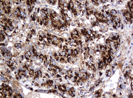 GLB1 / Beta-Galactosidase Antibody - IHC of paraffin-embedded Carcinoma of Human liver tissue using anti-GLB1 mouse monoclonal antibody.