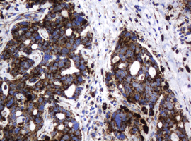 GLB1 / Beta-Galactosidase Antibody - IHC of paraffin-embedded Adenocarcinoma of Human breast tissue using anti-GLB1 mouse monoclonal antibody.