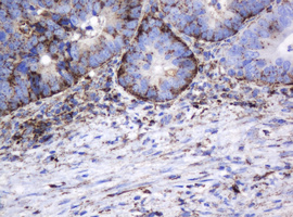 GLB1 / Beta-Galactosidase Antibody - IHC of paraffin-embedded Adenocarcinoma of Human colon tissue using anti-GLB1 mouse monoclonal antibody.