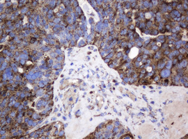 GLB1 / Beta-Galactosidase Antibody - IHC of paraffin-embedded Adenocarcinoma of Human ovary tissue using anti-GLB1 mouse monoclonal antibody.