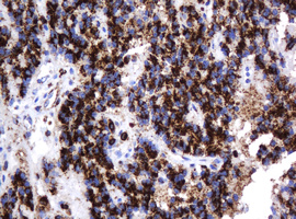 GLB1 / Beta-Galactosidase Antibody - IHC of paraffin-embedded Carcinoma of Human pancreas tissue using anti-GLB1 mouse monoclonal antibody.