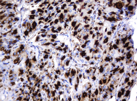 GLB1 / Beta-Galactosidase Antibody - IHC of paraffin-embedded Carcinoma of Human thyroid tissue using anti-GLB1 mouse monoclonal antibody.