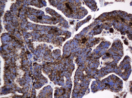 GLB1 / Beta-Galactosidase Antibody - IHC of paraffin-embedded Adenocarcinoma of Human endometrium tissue using anti-GLB1 mouse monoclonal antibody.