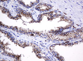 GLB1 / Beta-Galactosidase Antibody - IHC of paraffin-embedded Carcinoma of Human prostate tissue using anti-GLB1 mouse monoclonal antibody.