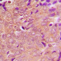 GLB1 / Beta-Galactosidase Antibody - Immunohistochemical analysis of Beta-galactosidase staining in human breast cancer formalin fixed paraffin embedded tissue section. The section was pre-treated using heat mediated antigen retrieval with sodium citrate buffer (pH 6.0). The section was then incubated with the antibody at room temperature and detected using an HRP polymer system. DAB was used as the chromogen. The section was then counterstained with hematoxylin and mounted with DPX.