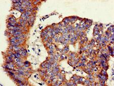 GLB1 / Beta-Galactosidase Antibody - Immunohistochemistry of paraffin-embedded human colon cancer at dilution of 1:100
