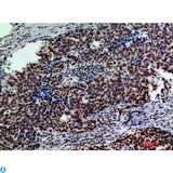 GLB1 / Beta-Galactosidase Antibody - Immunohistochemistry (IHC) analysis of paraffin-embedded Human Colont-cancer, antibody was diluted at 1:200.