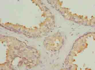 GLB1L2 Antibody - Immunohistochemistry of paraffin-embedded human prostate cancer using antibody at dilution of 1:100.