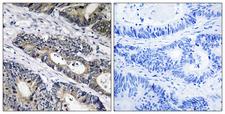 GLB1L3 Antibody - Immunohistochemistry analysis of paraffin-embedded human colon carcinoma, using GLB1L3 Antibody. The picture on the right is blocked with the synthesized peptide.