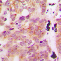 GLB1L3 Antibody - Immunohistochemical analysis of GLB1L3 staining in human breast cancer formalin fixed paraffin embedded tissue section. The section was pre-treated using heat mediated antigen retrieval with sodium citrate buffer (pH 6.0). The section was then incubated with the antibody at room temperature and detected using an HRP conjugated compact polymer system. DAB was used as the chromogen. The section was then counterstained with hematoxylin and mounted with DPX.