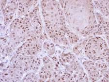 GLE1 Antibody - IHC of paraffin-embedded Cal27 xenograft using GLE1 antibody at 1:500 dilution.