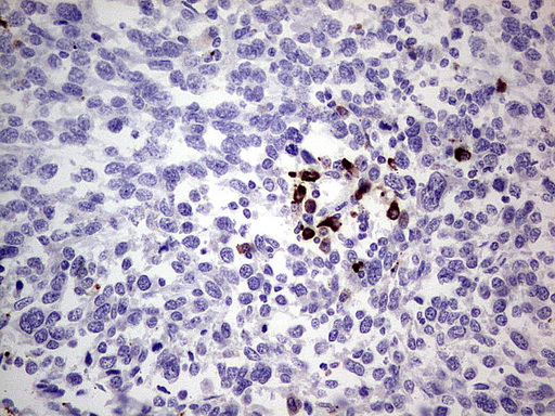 GLI / GLI1 Antibody - Immunohistochemical staining of paraffin-embedded Human melanoma tissue using anti-GLI1 mouse monoclonal antibody.  heat-induced epitope retrieval by 1 mM EDTA in 10mM Tris, pH8.0, 120C for 3min)