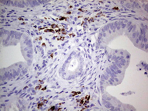 GLI / GLI1 Antibody - Immunohistochemical staining of paraffin-embedded Adenocarcinoma of Human colon tissue using anti-GLI1 mouse monoclonal antibody.  heat-induced epitope retrieval by 1 mM EDTA in 10mM Tris, pH8.0, 120C for 3min)