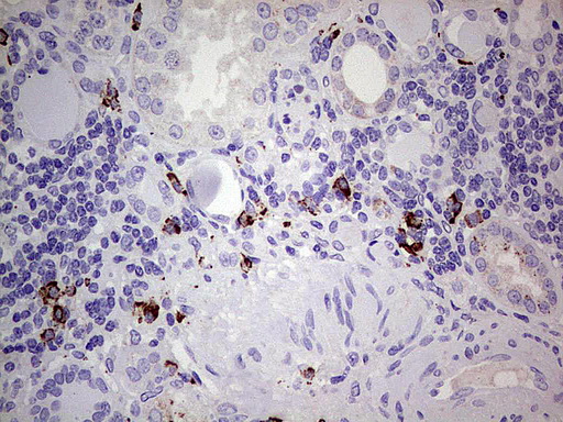 GLI / GLI1 Antibody - Immunohistochemical staining of paraffin-embedded Human Kidney tissue using anti-GLI1 mouse monoclonal antibody.  heat-induced epitope retrieval by 1 mM EDTA in 10mM Tris, pH8.0, 120C for 3min)