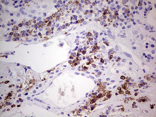 GLI / GLI1 Antibody - Immunohistochemical staining of paraffin-embedded Carcinoma of Human bladder tissue using anti-GLI1 mouse monoclonal antibody.  heat-induced epitope retrieval by 1 mM EDTA in 10mM Tris, pH8.0, 120C for 3min)