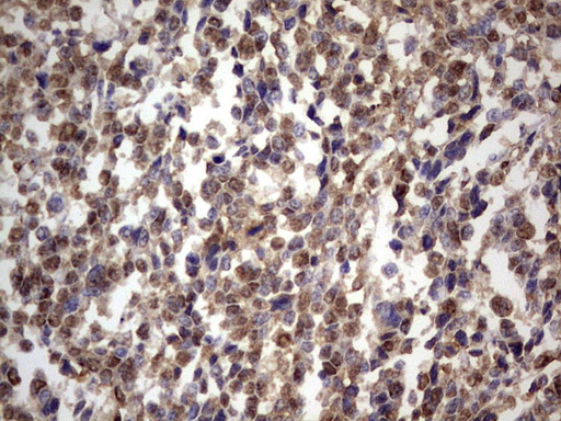 GLI / GLI1 Antibody - IHC of paraffin-embedded Human melanoma tissue using anti-GLI1 mouse monoclonal antibody. (Heat-induced epitope retrieval by 1 mM EDTA in 10mM Tris, pH8.5, 120°C for 3min).
