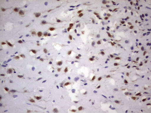 GLI / GLI1 Antibody - IHC of paraffin-embedded Human adult brain tissue using anti-GLI1 mouse monoclonal antibody. (Heat-induced epitope retrieval by 1 mM EDTA in 10mM Tris, pH8.5, 120°C for 3min).