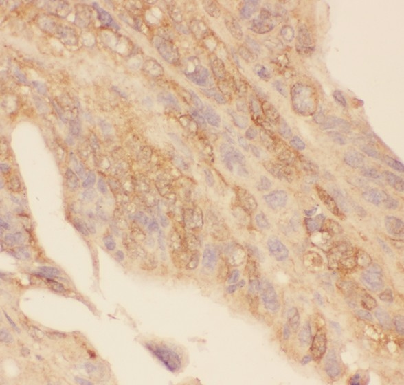 GLI / GLI1 Antibody - Gli1 antibody IHC-paraffin: Human Intestinal Cancer Tissue.